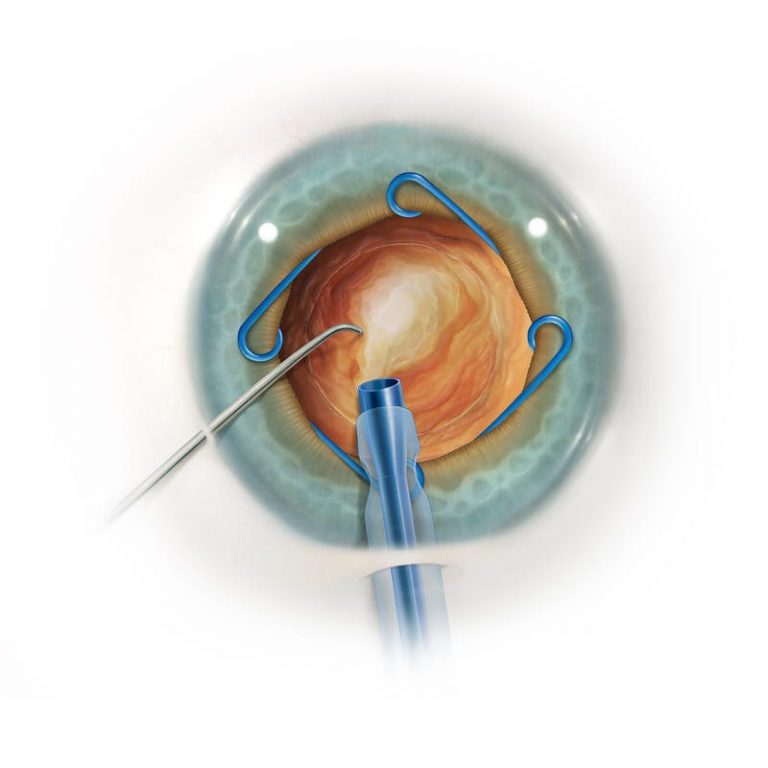 RETRACTOR DE IRIS Oftomed